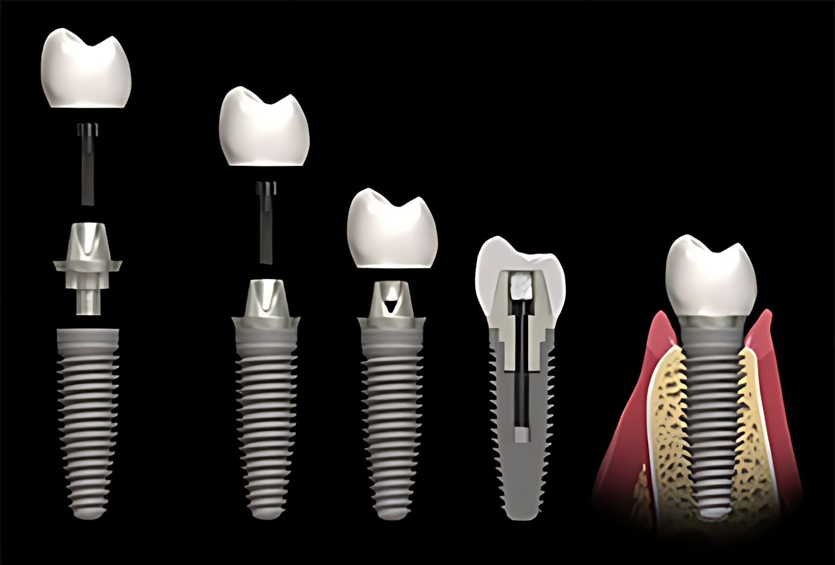 Impianto osteoporosi upscayl 3x upscayl lite 4x